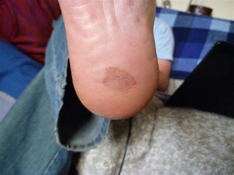 stone bruise pictures|bruising at base of toes.